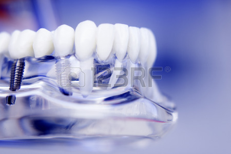 Implantologia Dentale a Roma
